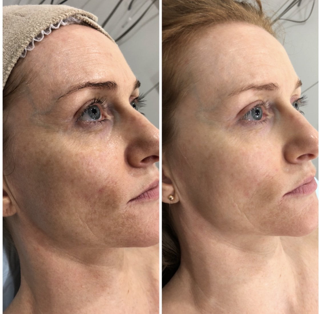 Micro Needling Facial Rejuvenation The Salon