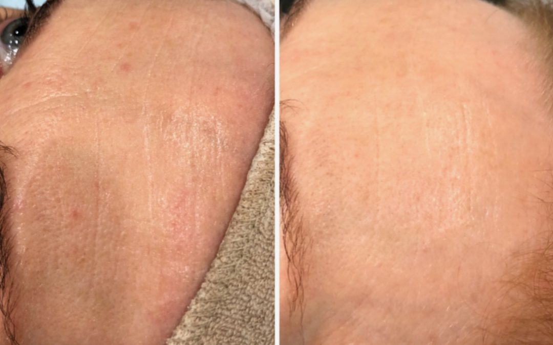 Micro Needling before and after